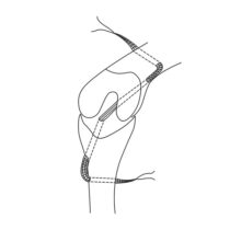 ZLig – técnica de reemplazo del ligamento cruzado intraarticular, EICKEMEYER